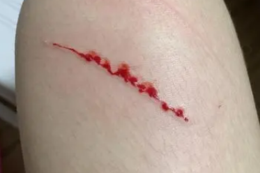 被打过疫苗的猫抓伤出血要打针吗
