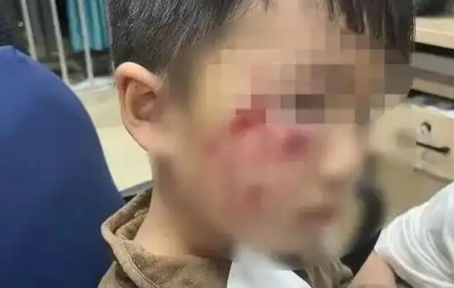 3岁男童被狗咬后18天离世 3岁男童被狗咬后18天离世