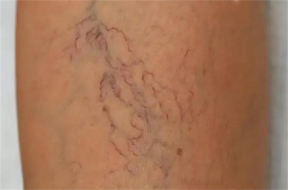 腿上的小蚯蚓越来越多.png