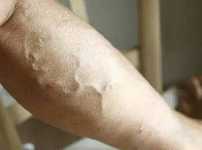 小腿有蚯蚓出现是病吗