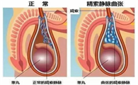 左侧睾丸有蚯蚓状东西