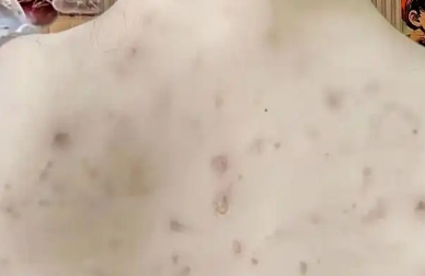 感觉全身都是螨虫怎么办