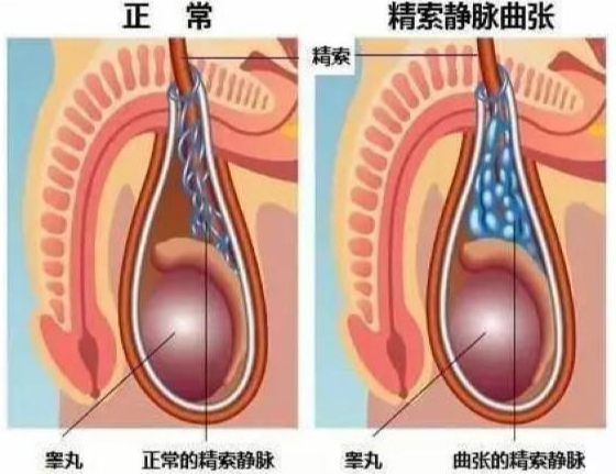 左侧睾丸有蚯蚓状东西