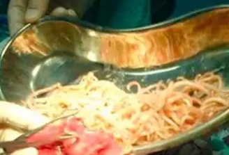 宝宝肚子里有蛔虫是什么症状
