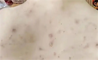 感觉全身都是螨虫怎么办