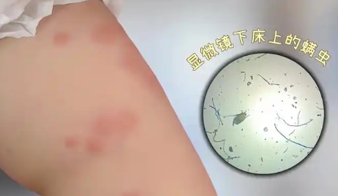 孩子身上有螨虫的症状