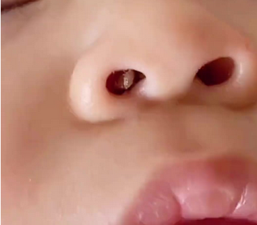 鼻孔里有虫子蠕动般很痒