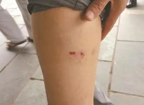 天热动物攻击性强 被猫狗咬伤尽早接种疫苗 天热动物攻击性强 被猫狗咬伤尽早接种疫苗