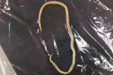 怎么知道孩子有没有蛔虫 怎么知道孩子有没有蛔虫