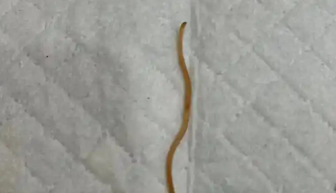 肛门里有蛔虫怎么办 肛门里有蛔虫怎么办