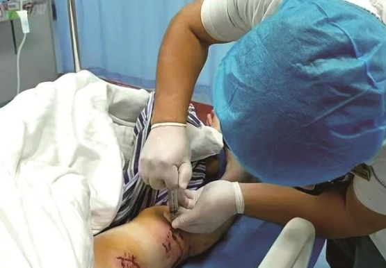 女子被野猫袭击，手背肌腱被咬断裂