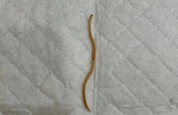 什么情况下会口吐蛔虫 什么情况下会口吐蛔虫