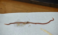 9个月宝宝有蛔虫症状