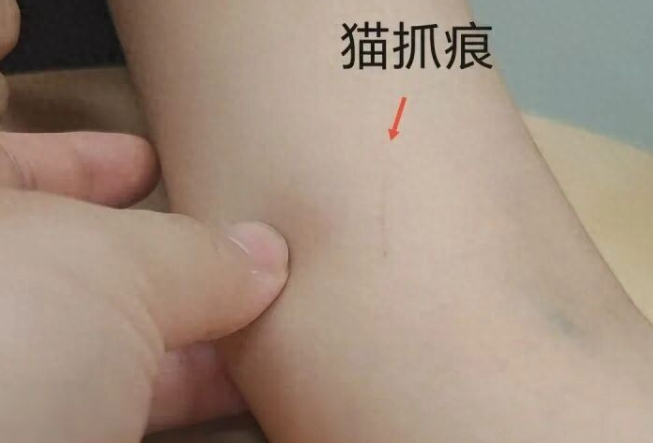 19岁女孩回老家抱了一下猫，三天后肘部突然长出包块
